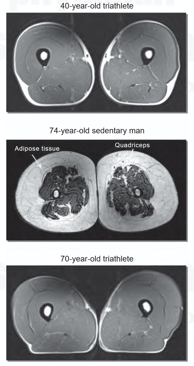 Magnetic resonance images of thigh cross-sections from three men: a 40 year old triathlete with large uniform quadriceps, a 74 year old sedentary man whose quadriceps are smaller and surrounded by a thick layer of adipose tissue, and a 70 year old triathlete whose quadriceps closely resemble the 40 year old's.